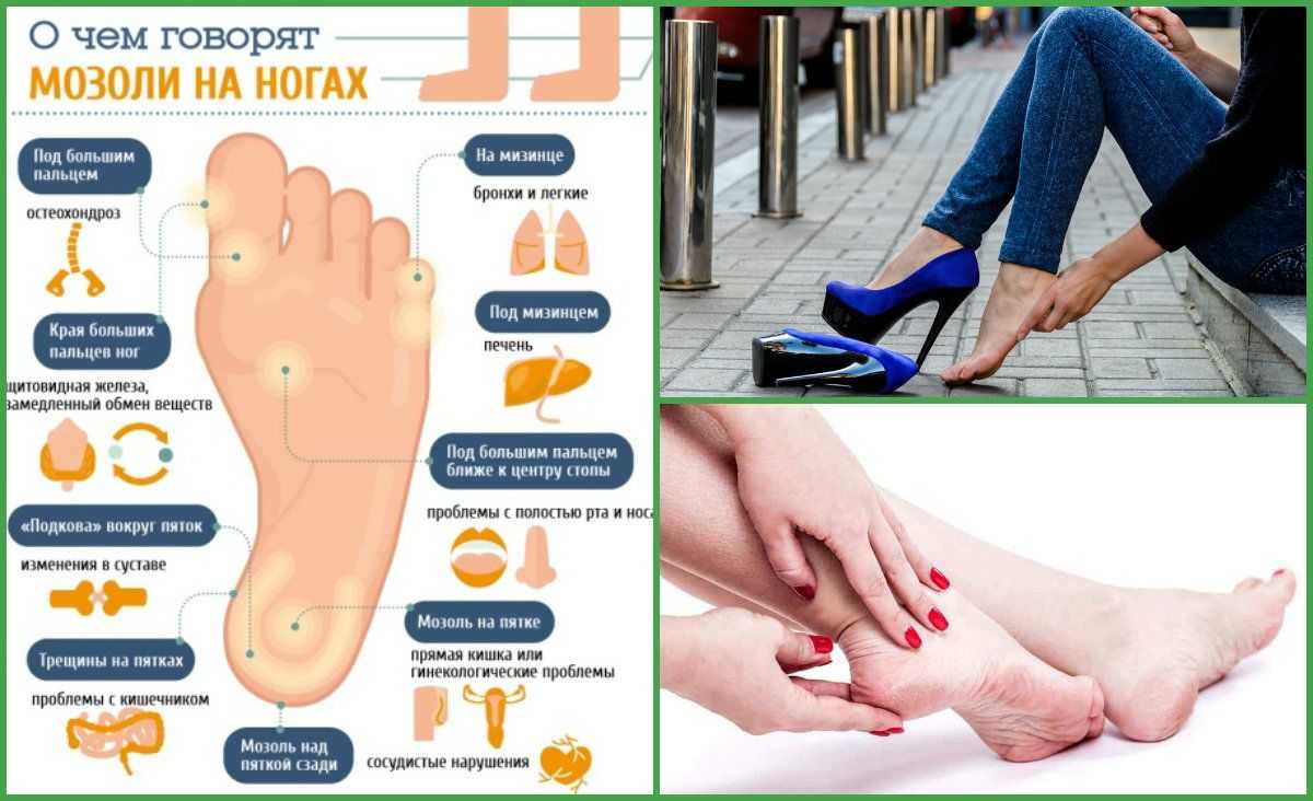 Болит большой палец на ноге | причины боли пальца на ноге, диагностика и лечение